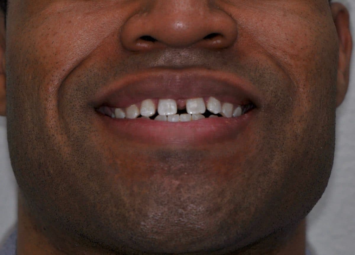 Before treatment