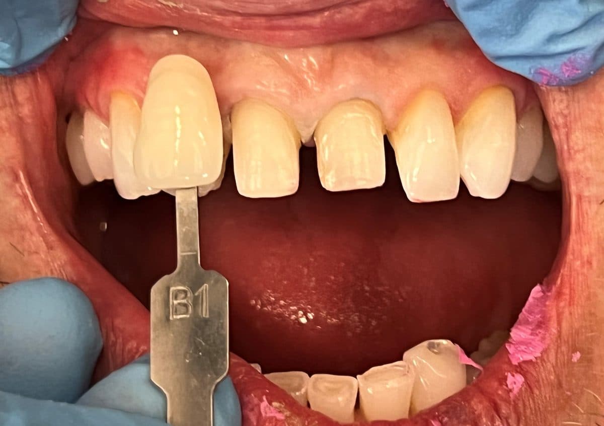 Before treatment