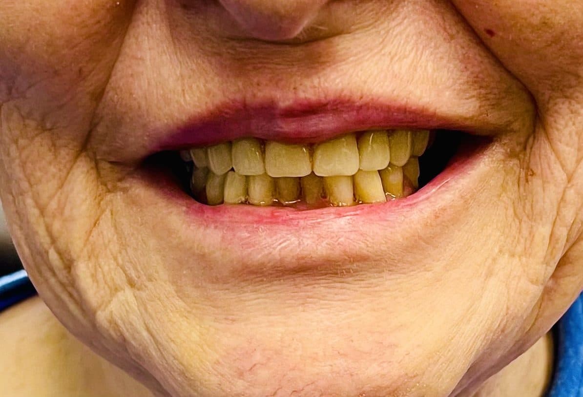 Before treatment
