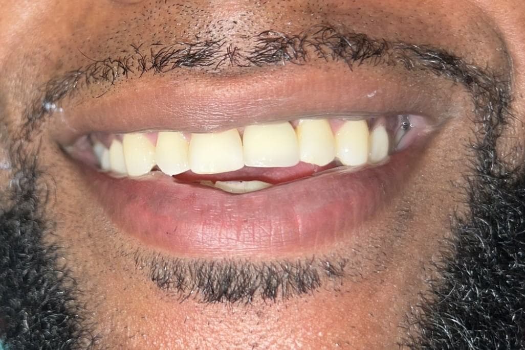 After treatment