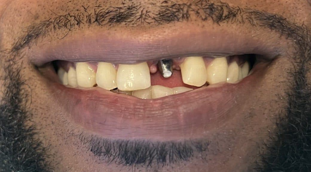 Before treatment