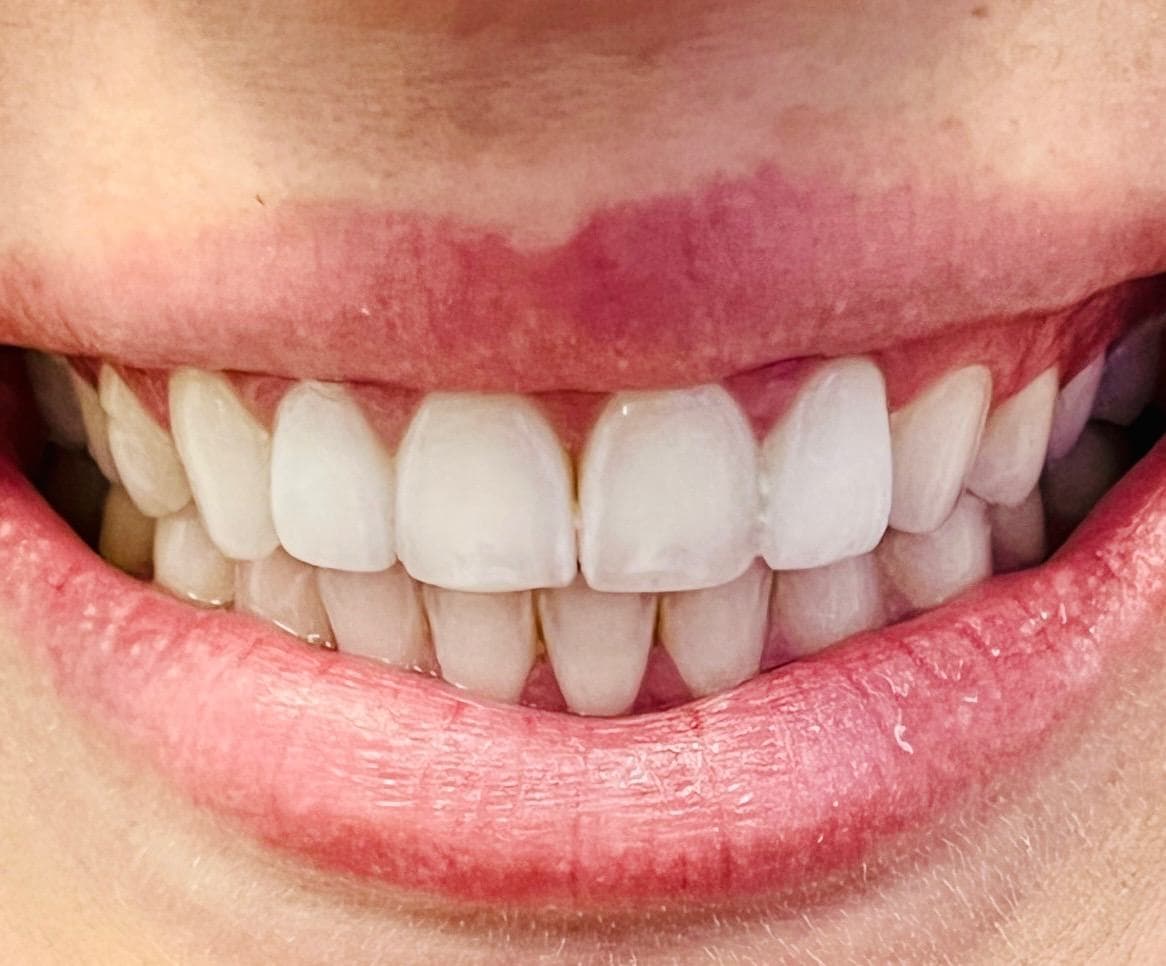 After treatment