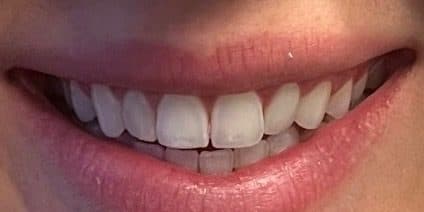 Before treatment